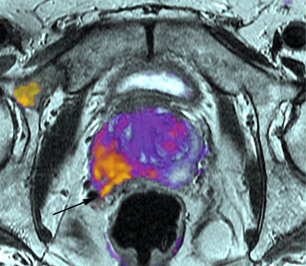 new-imaging-technique-for-improved-prostate-cancer-detection-and